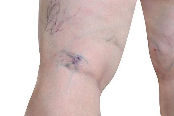 واریس پشت زانو: علل، علائم و روش‌های درمانی